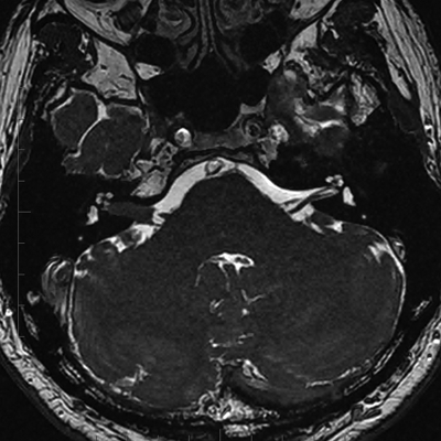 RM Fosa posterior