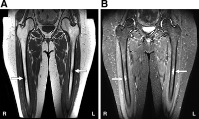 RM Muslo o Femur