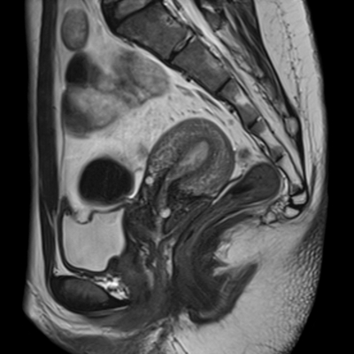 RM Pelvis femenina