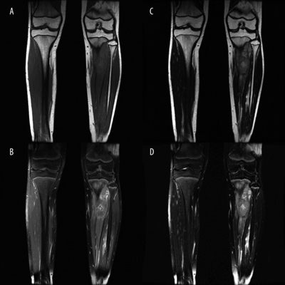 RM Pierna o Tibia