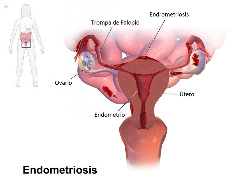 Endometriosis | Proimagem