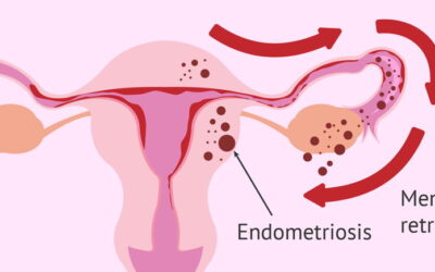 Resonancia magnética de pelvis femenina para diagnóstico de Endometriosis